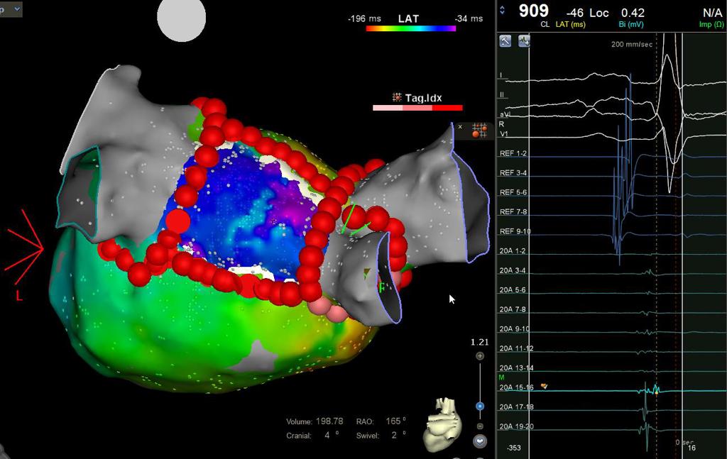 Dr franck Halimi, Epicardial connexion in a posterior box