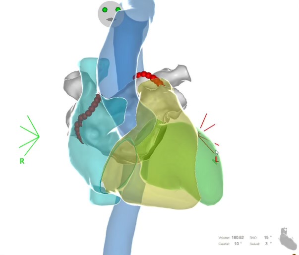 Dr franck Halimi, Ablation tridimensionnelle de la FA