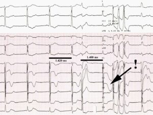 Torsade de pointes BAV 2.1 et debut TdP sans allongt Dr Franck Halimi Rythmologue Paris